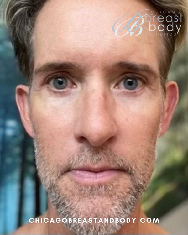 Patient after full facelift with neck lift by Dr. Rachel