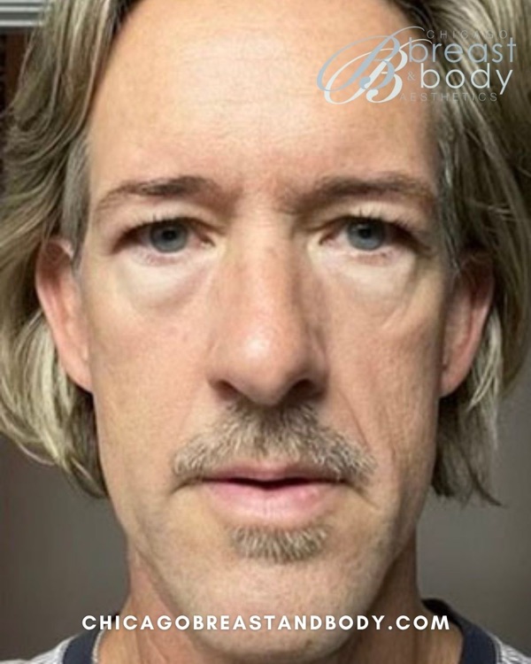 Patient before full facelift with neck lift by Dr. Rachel