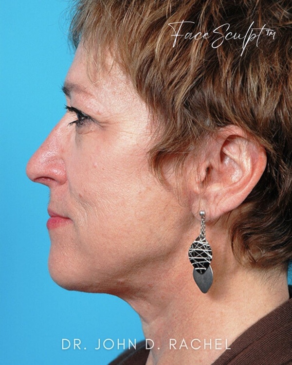 Patient after traditional facelift by Dr. Rachel
