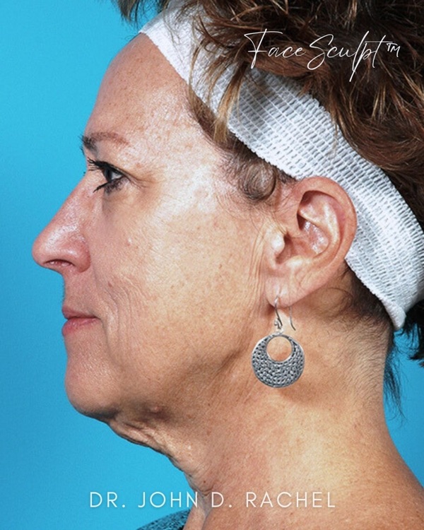 Patient before traditional facelift by Dr. Rachel