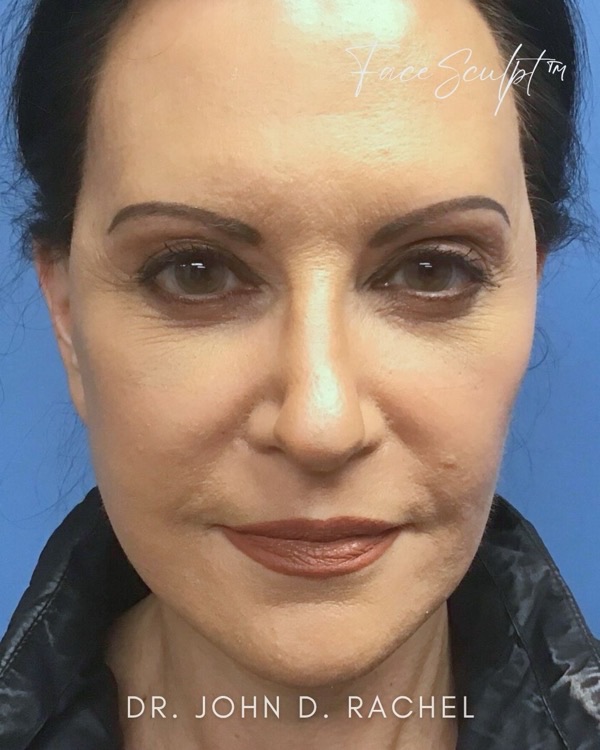 Patient after mini facelift by Dr. Rachel