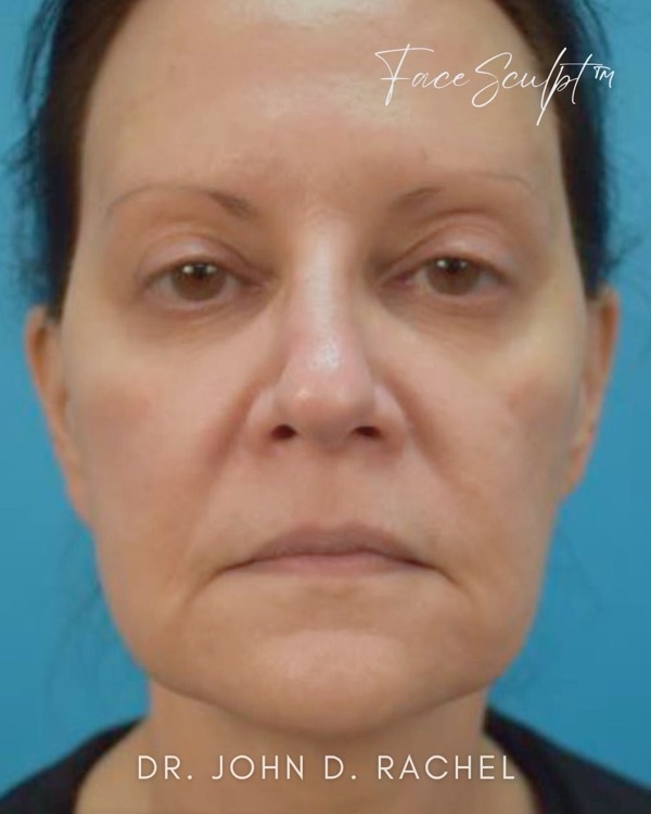 Patient before mini facelift by Dr. Rachel